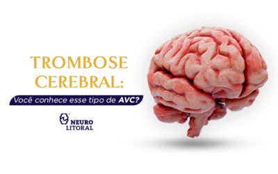 Trombose cerebral: Você conhece esse tipo de AVC?