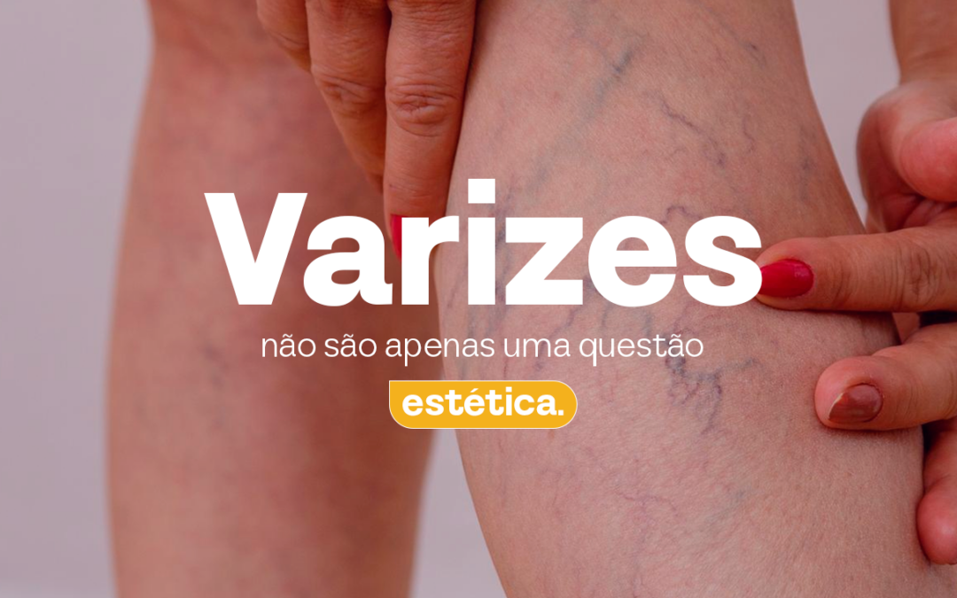 Varizes não são apenas uma questão estética.